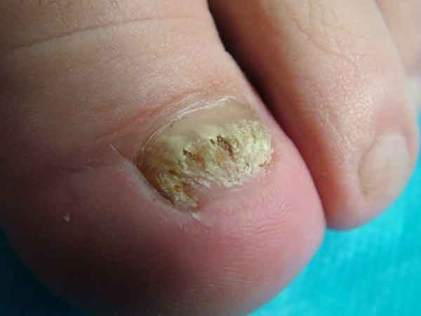 ��ָ�׵�֢״,�ɶ�����ҽԺ