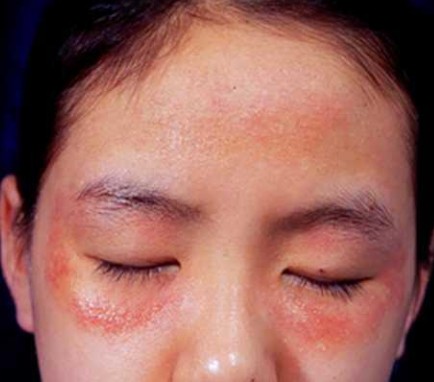 ʪ���֢״,�ɶ�����ҽԺ