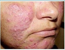 痤疮的危害,成都军大医院