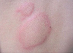 荨麻疹的护理,成都军大医院